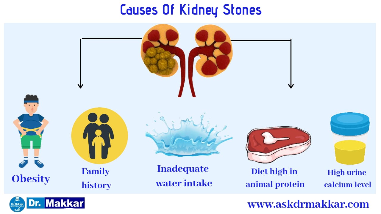 kidney-stones-online-homeopathic-treatment-india-removed-naturally